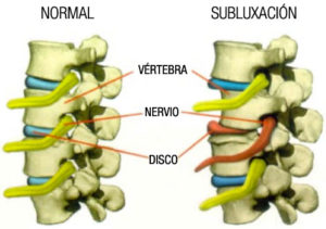 Quiropráctica Subluxacion y pinzamiento de nervios