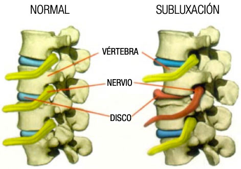 Hernia o protrusión discal